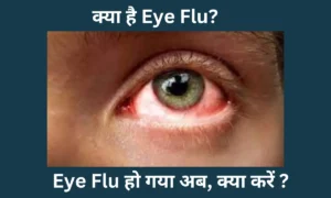 Read more about the article Eye Flu का कहर, कैसे बचें, क्यों फेल रही है ये बीमारी